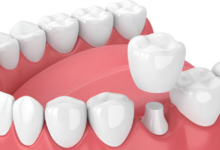 New Dental Crowns: Essential Tips for Long-Lasting Results