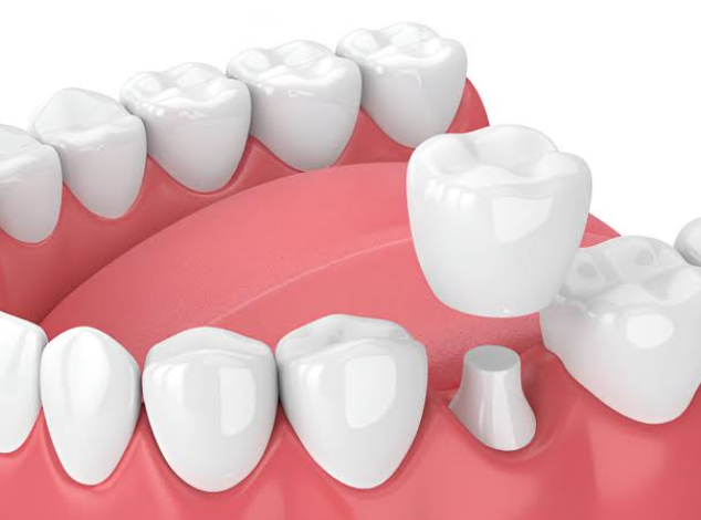 New Dental Crowns: Essential Tips for Long-Lasting Results